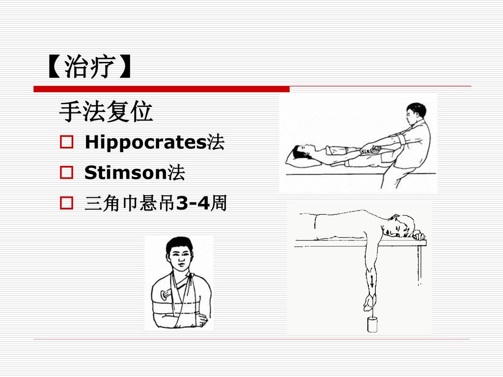 【治疗】 手法复位 Hippocrates法 Stimson法 三角巾悬吊3-4周
