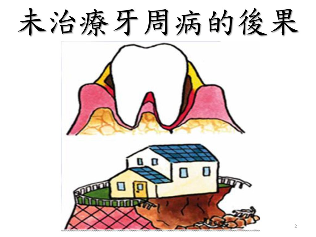 未治療牙周病的後果 這張就是牙周病未治療的後果, 牙結石累積太多，造成牙齦萎縮與牙床吸收，此時牙齒隨時會掉下來。