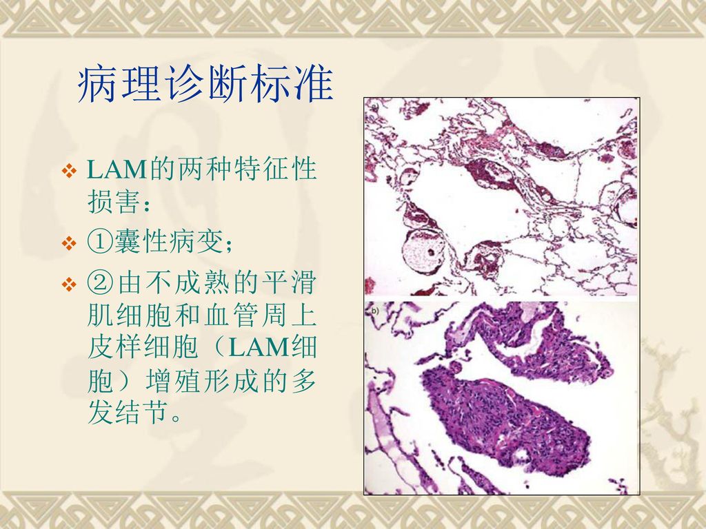 肺淋巴管肌瘤病的 Pulmonary Lymphangiomyomatosis 临床及ct表现 Ppt Download