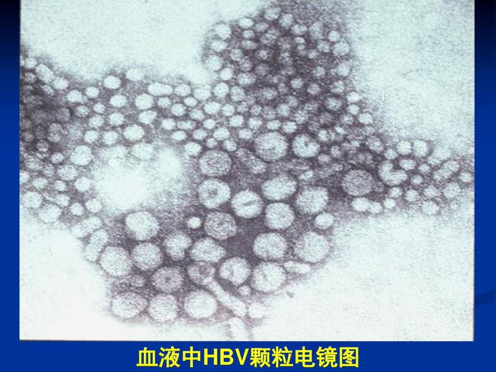 Fig. 5.6 Viral hepatitis: electron micrograph of hepatitis B virus, serum specimen. The smaller rounded structures are non-IFNectious particles containing HBsAg determinant on their surfaces. HBsAg can also be seen in tubular or filamentous form. The larger （40-50 nm diameter） rounded bodies are Dane particles, probably the fully assembled IFNectious virus. By courtesy of Professor C.R. Madely.