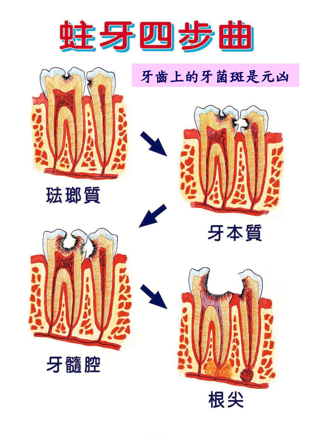 牙齒上的牙菌斑是元凶