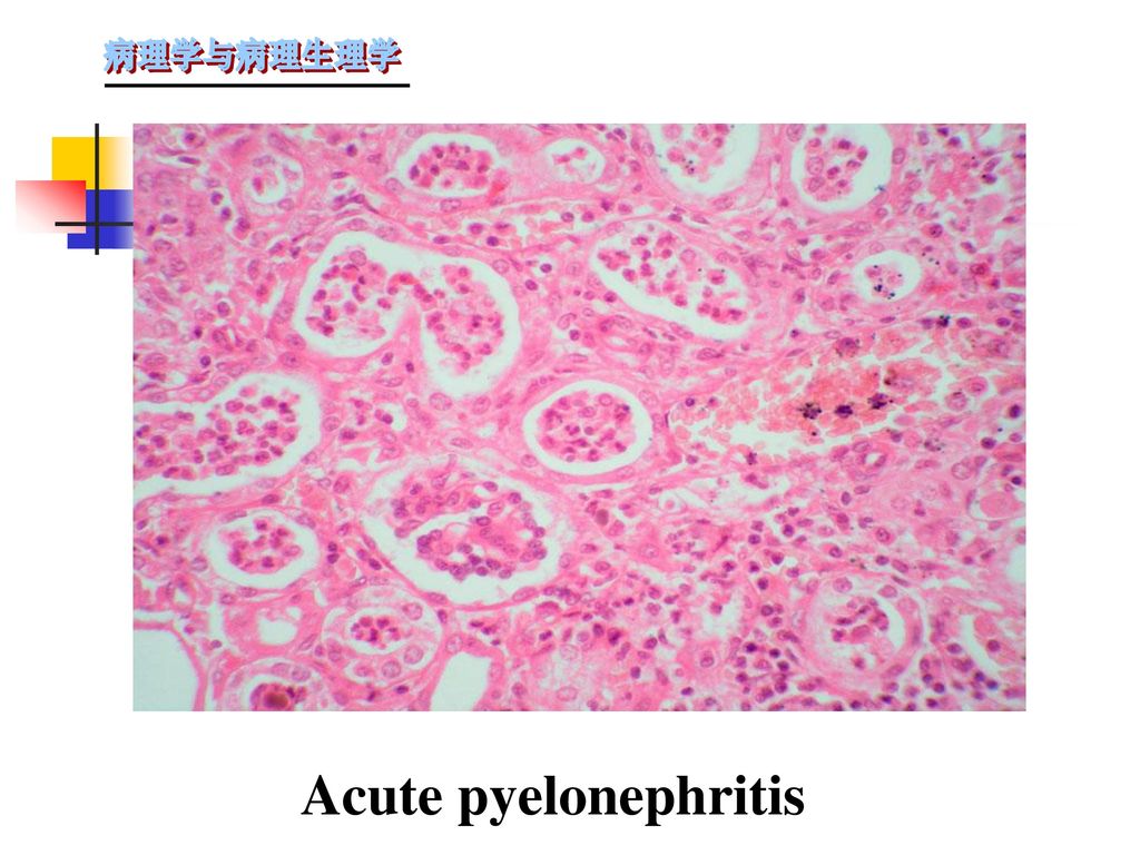 Acute pyelonephritis