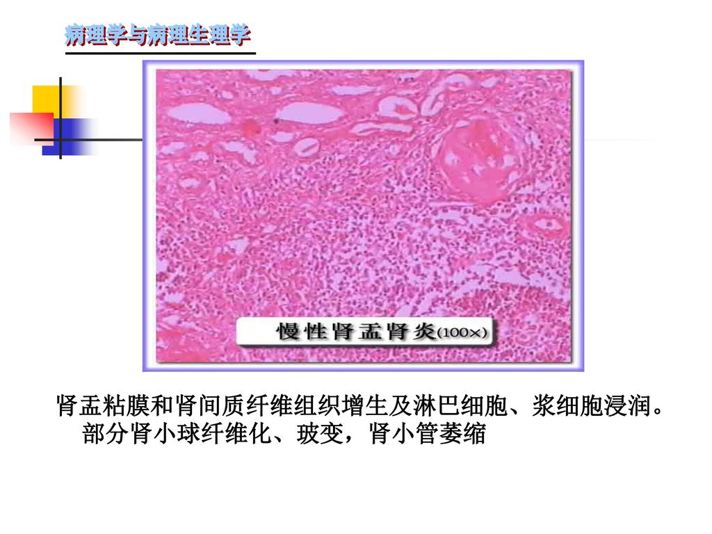 肾盂粘膜和肾间质纤维组织增生及淋巴细胞、浆细胞浸润。部分肾小球纤维化、玻变，肾小管萎缩
