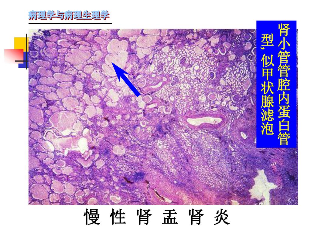 肾小管管腔内蛋白管型,似甲状腺滤泡 慢 性 肾 盂 肾 炎