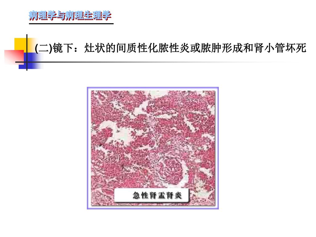 (二)镜下：灶状的间质性化脓性炎或脓肿形成和肾小管坏死