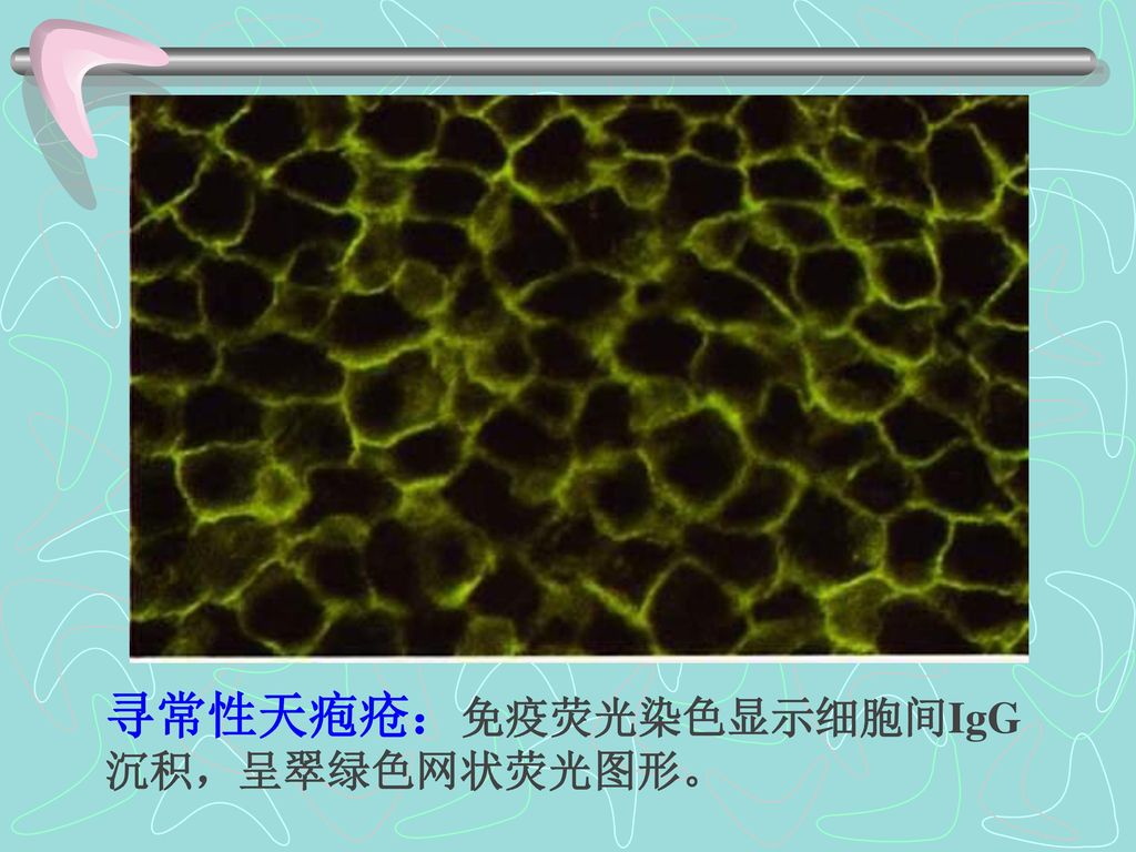寻常性天疱疮：免疫荧光染色显示细胞间IgG沉积，呈翠绿色网状荧光图形。