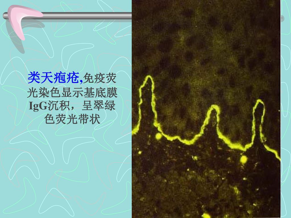 类天疱疮,免疫荧光染色显示基底膜IgG沉积，呈翠绿色荧光带状