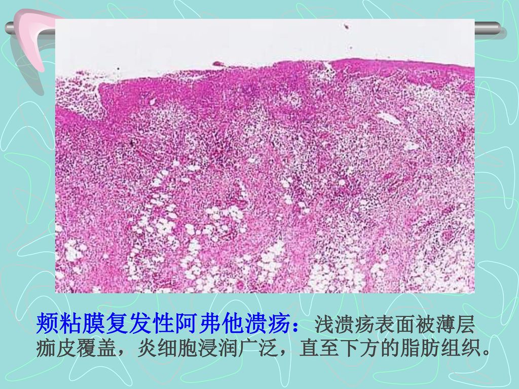颊粘膜复发性阿弗他溃疡：浅溃疡表面被薄层痂皮覆盖，炎细胞浸润广泛，直至下方的脂肪组织。