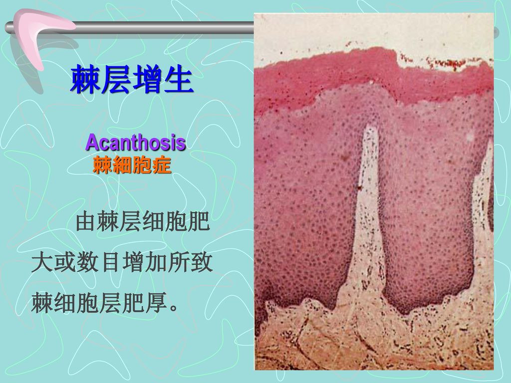 棘层增生 Acanthosis 棘細胞症 由棘层细胞肥大或数目增加所致棘细胞层肥厚。