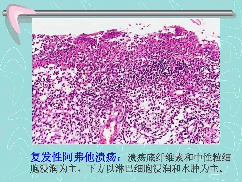 复发性阿弗他溃疡：溃疡底纤维素和中性粒细胞浸润为主，下方以淋巴细胞浸润和水肿为主。