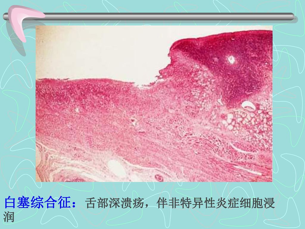 白塞综合征：舌部深溃疡，伴非特异性炎症细胞浸润