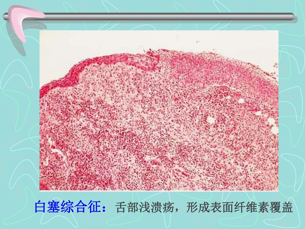 白塞综合征：舌部浅溃疡，形成表面纤维素覆盖