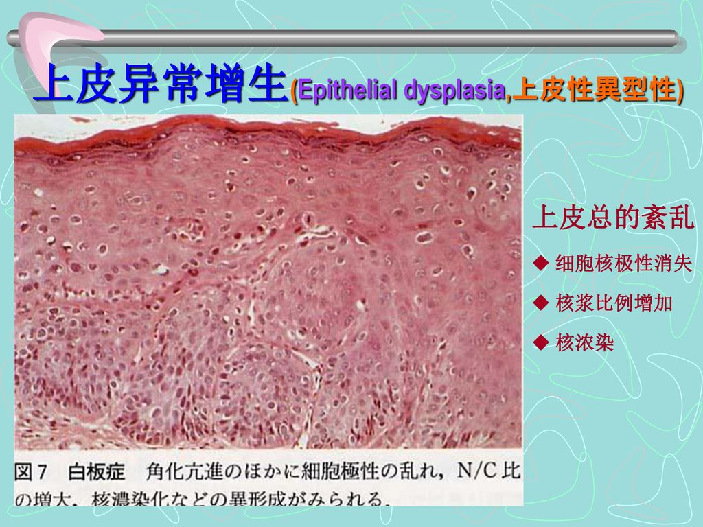 上皮异常增生(Epithelial dysplasia,上皮性異型性)