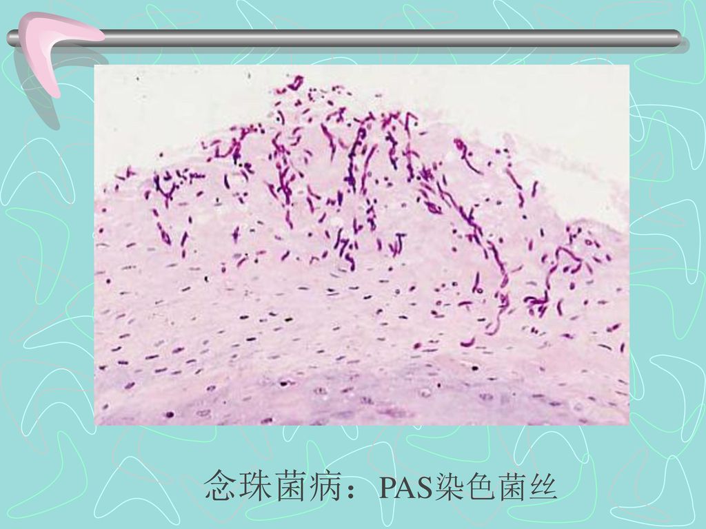 念珠菌病：PAS染色菌丝