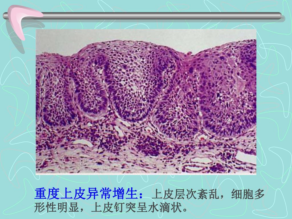 重度上皮异常增生：上皮层次紊乱，细胞多形性明显，上皮钉突呈水滴状。
