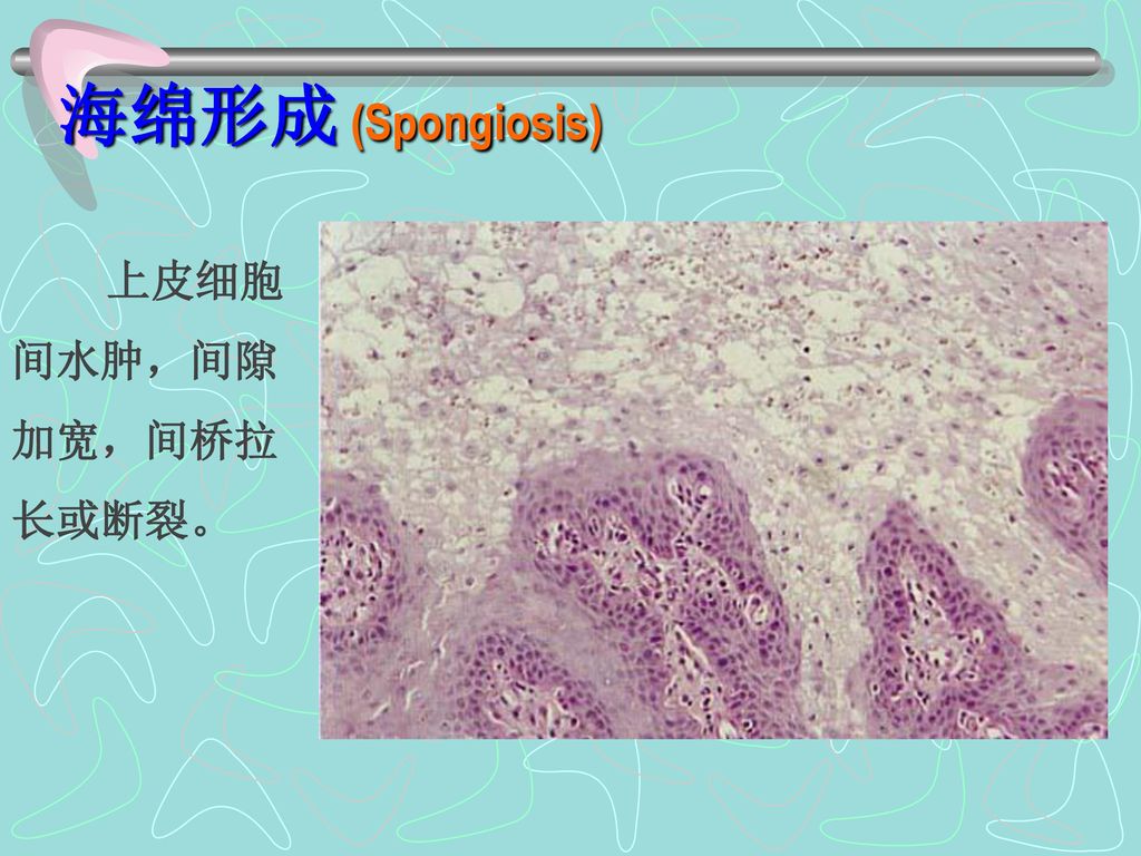 海绵形成 (Spongiosis) 上皮细胞间水肿，间隙加宽，间桥拉长或断裂。