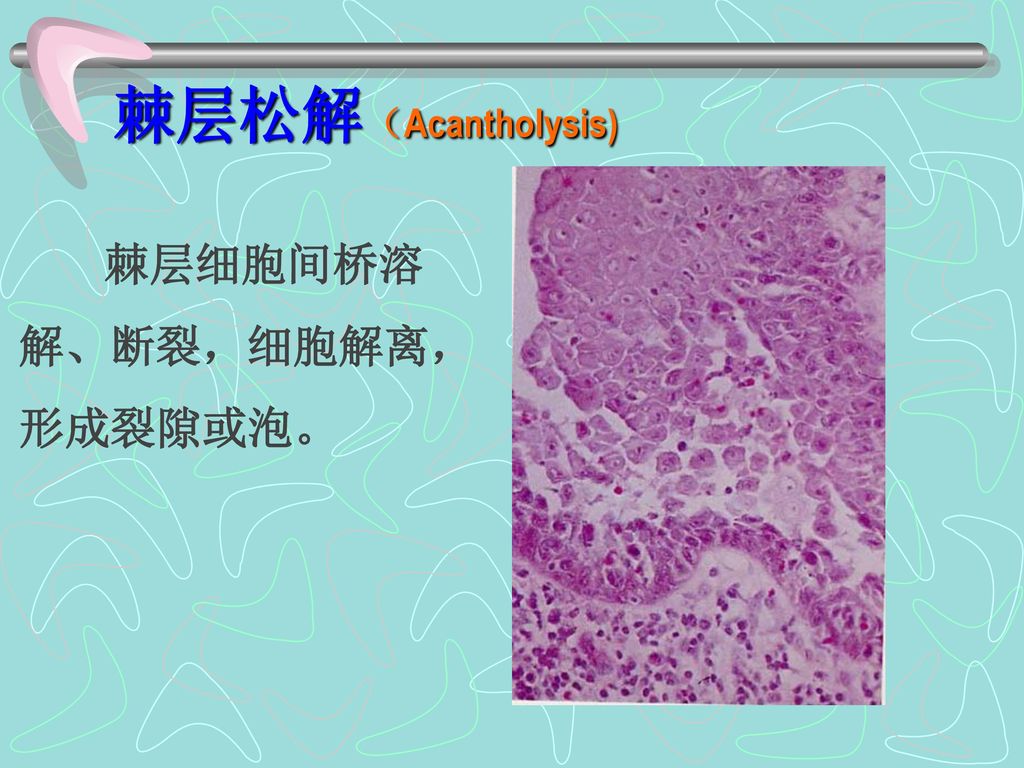 棘层松解（Acantholysis) 棘层细胞间桥溶解、断裂，细胞解离，形成裂隙或泡。