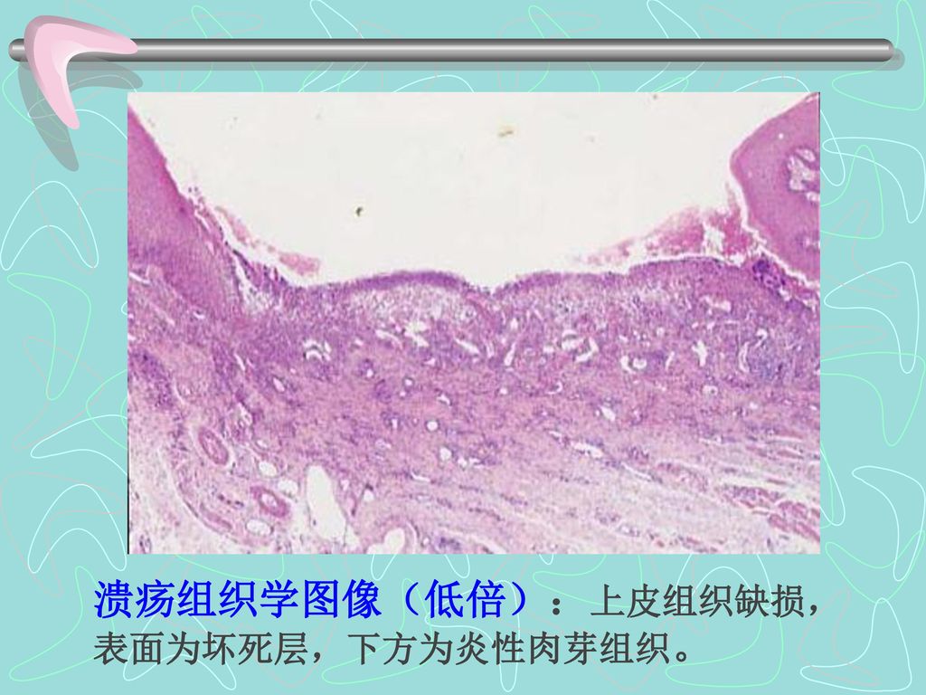 溃疡组织学图像（低倍）：上皮组织缺损，表面为坏死层，下方为炎性肉芽组织。
