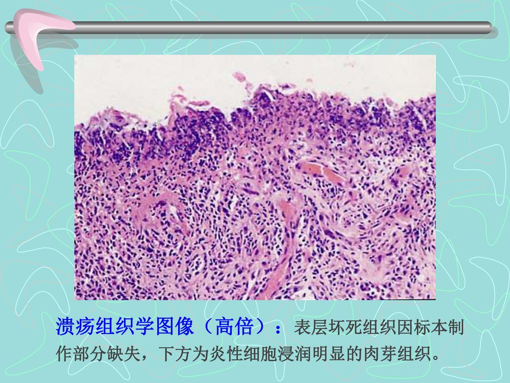 溃疡组织学图像（高倍）：表层坏死组织因标本制作部分缺失，下方为炎性细胞浸润明显的肉芽组织。