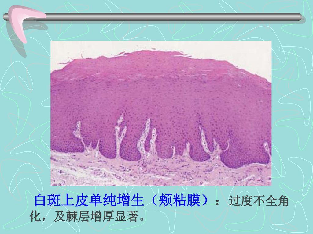 白斑上皮单纯增生（颊粘膜）：过度不全角化，及棘层增厚显著。