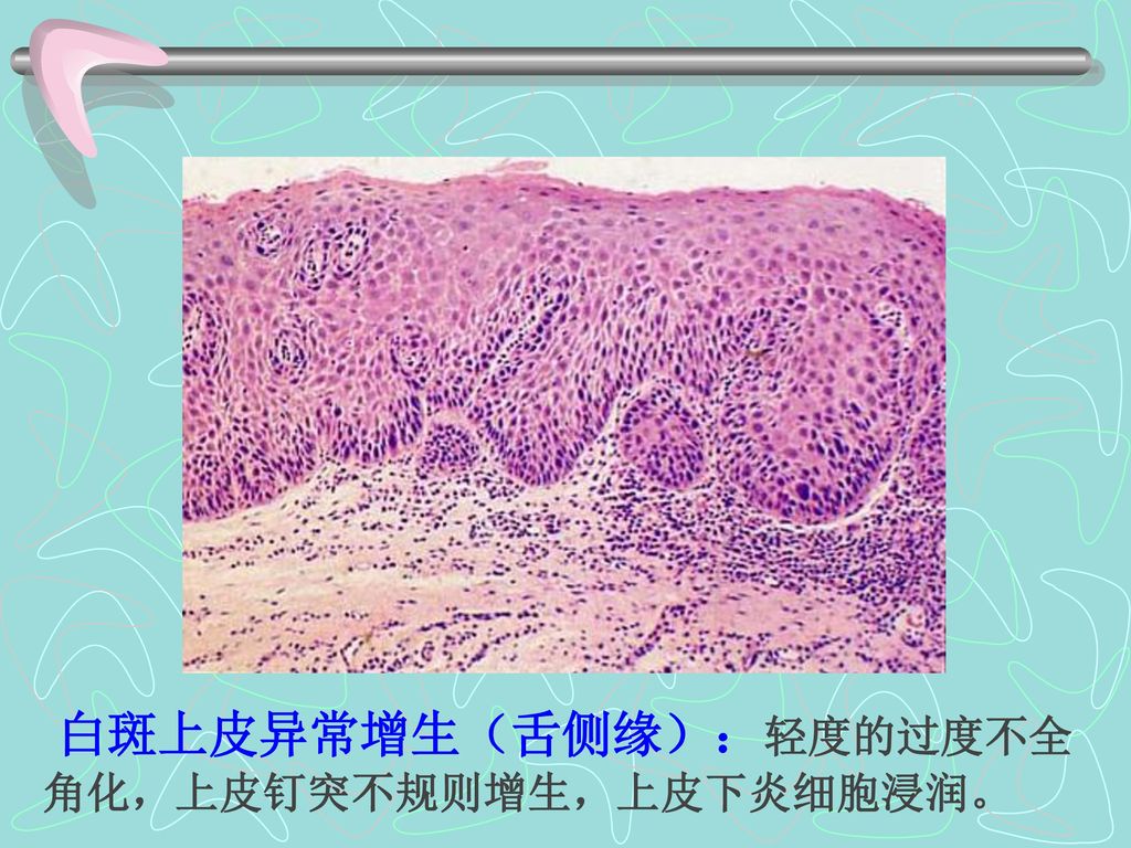 白斑上皮异常增生（舌侧缘）：轻度的过度不全角化，上皮钉突不规则增生，上皮下炎细胞浸润。