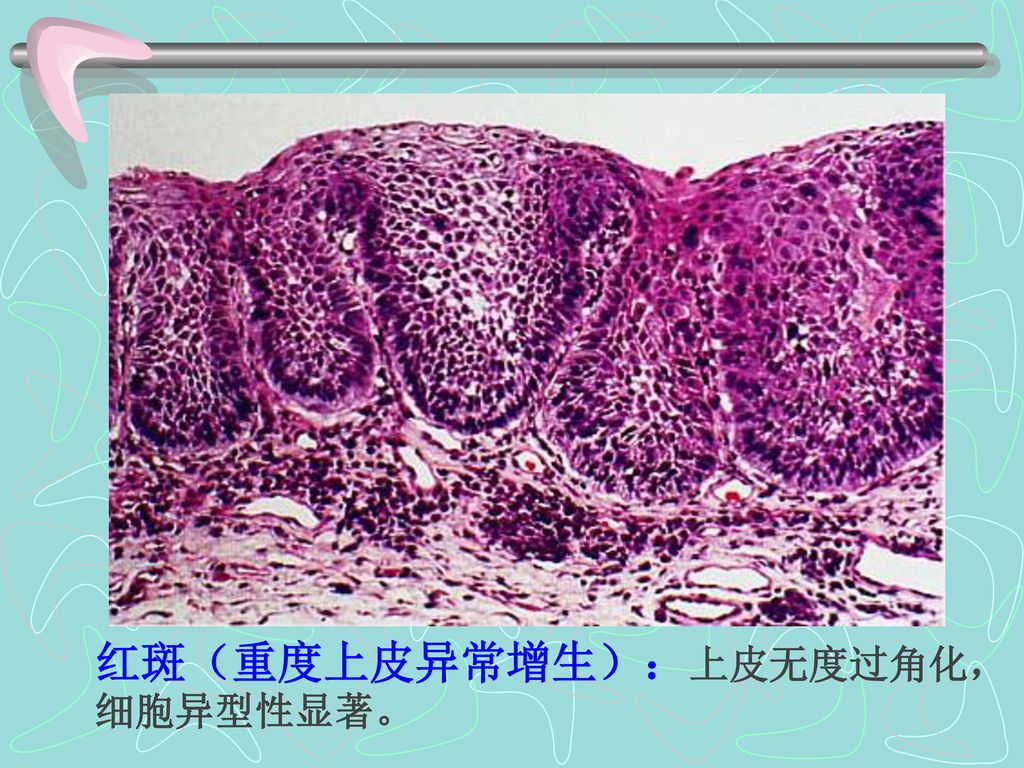 红斑（重度上皮异常增生）：上皮无度过角化，细胞异型性显著。