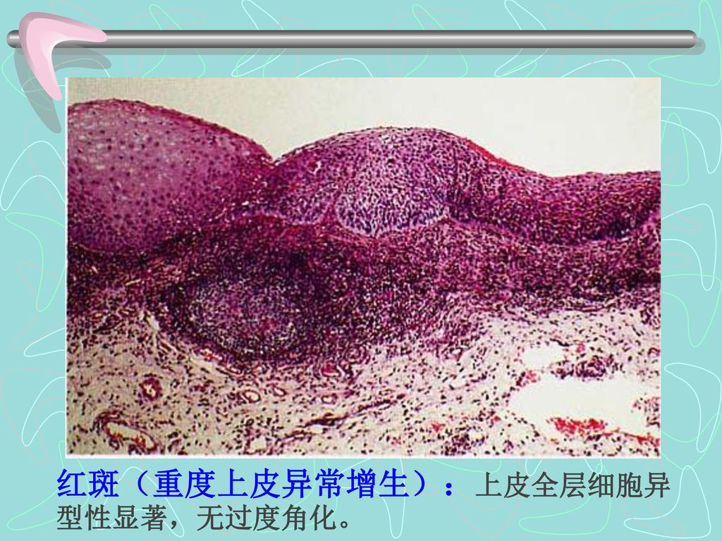 红斑（重度上皮异常增生）：上皮全层细胞异型性显著，无过度角化。