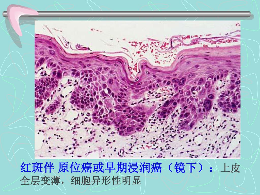 红斑伴 原位癌或早期浸润癌（镜下）：上皮全层变薄，细胞异形性明显