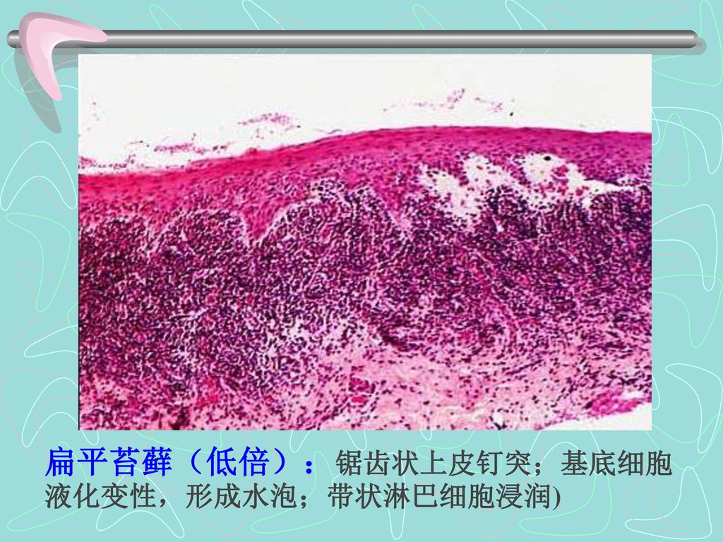 扁平苔藓（低倍）：锯齿状上皮钉突；基底细胞液化变性，形成水泡；带状淋巴细胞浸润)