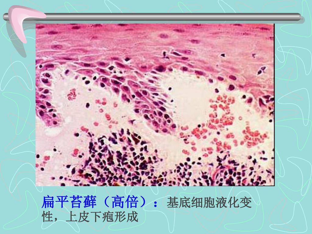 扁平苔藓（高倍）：基底细胞液化变性，上皮下疱形成