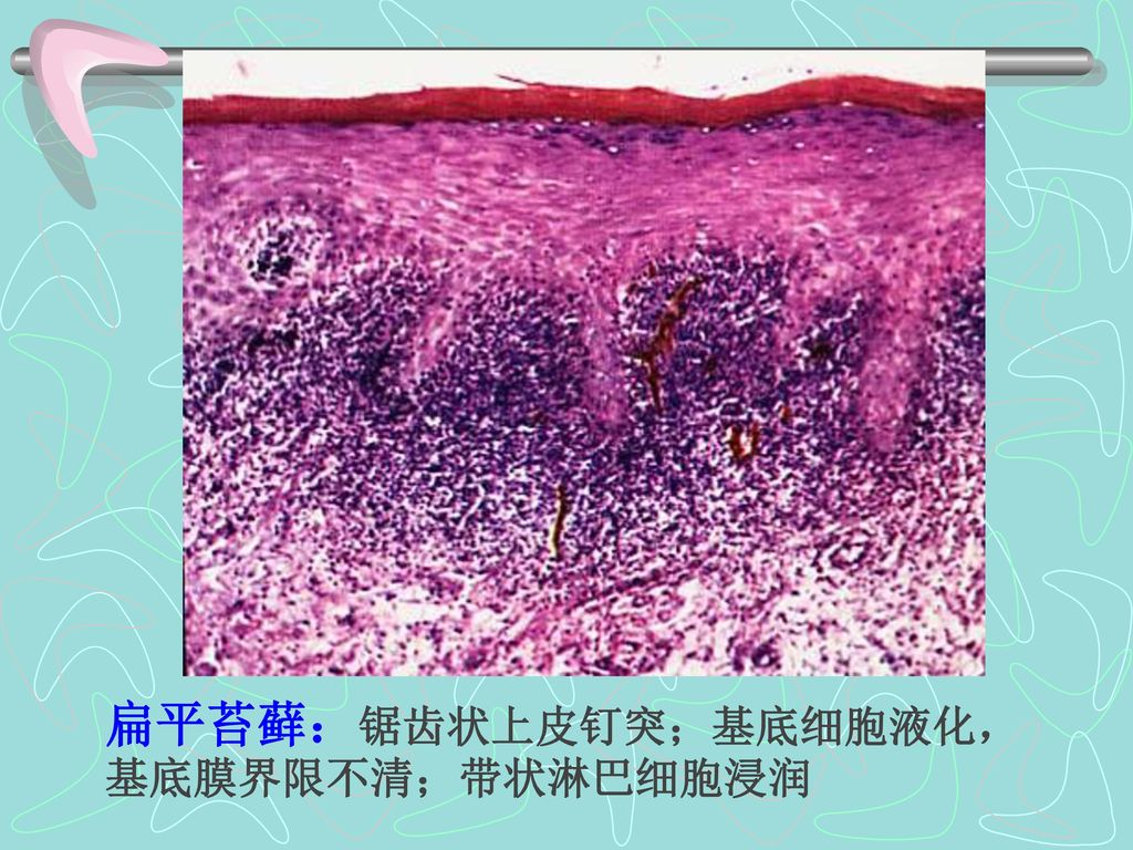 扁平苔藓：锯齿状上皮钉突；基底细胞液化，基底膜界限不清；带状淋巴细胞浸润