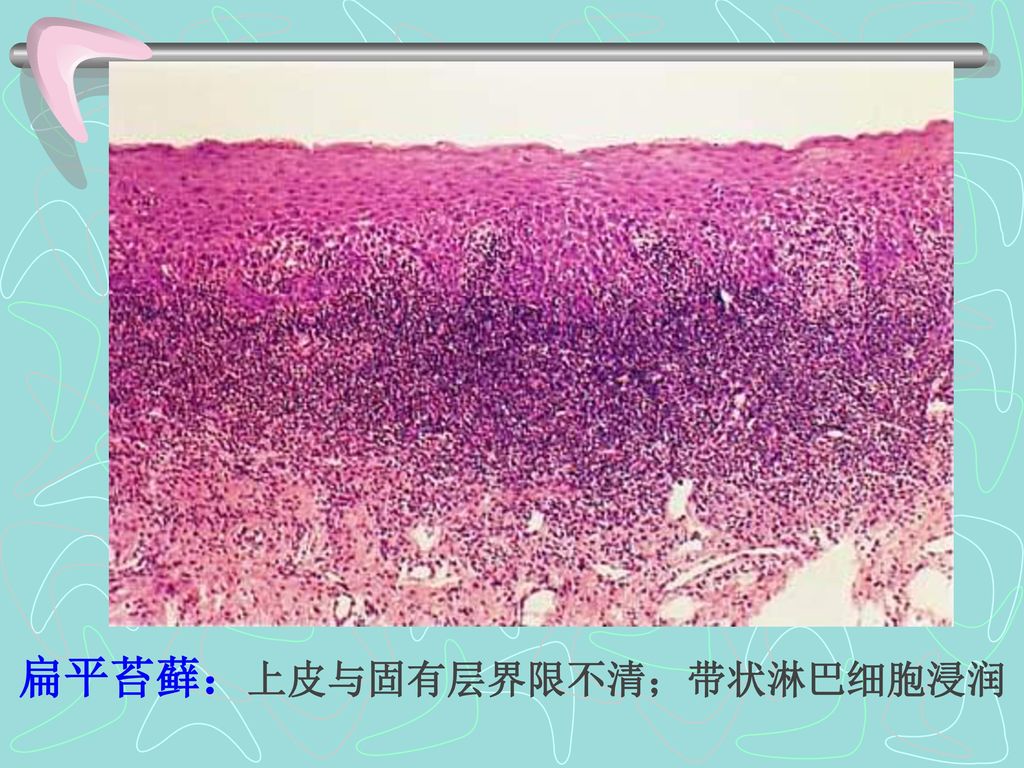扁平苔藓：上皮与固有层界限不清；带状淋巴细胞浸润