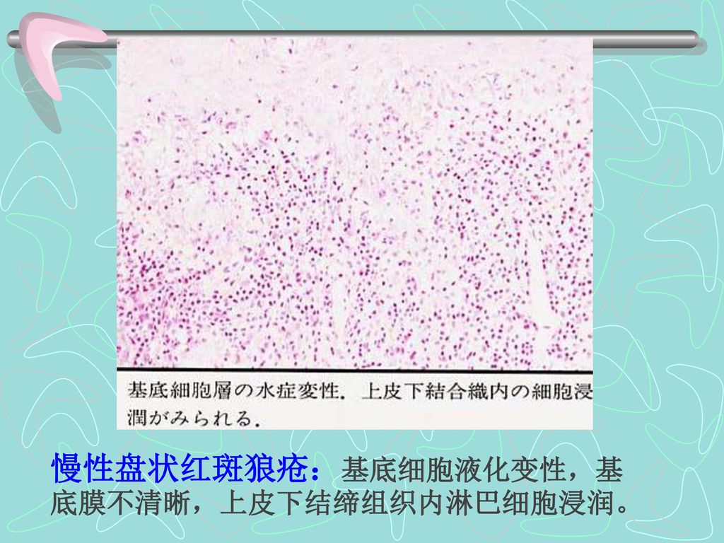 慢性盘状红斑狼疮：基底细胞液化变性，基底膜不清晰，上皮下结缔组织内淋巴细胞浸润。