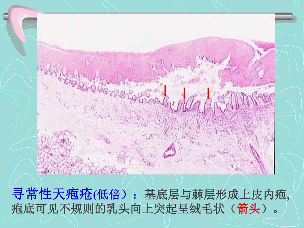寻常性天疱疮(低倍）：基底层与棘层形成上皮内疱,疱底可见不规则的乳头向上突起呈绒毛状（箭头）。