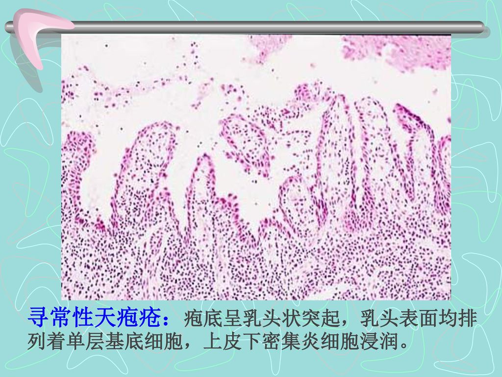 寻常性天疱疮：疱底呈乳头状突起，乳头表面均排列着单层基底细胞，上皮下密集炎细胞浸润。