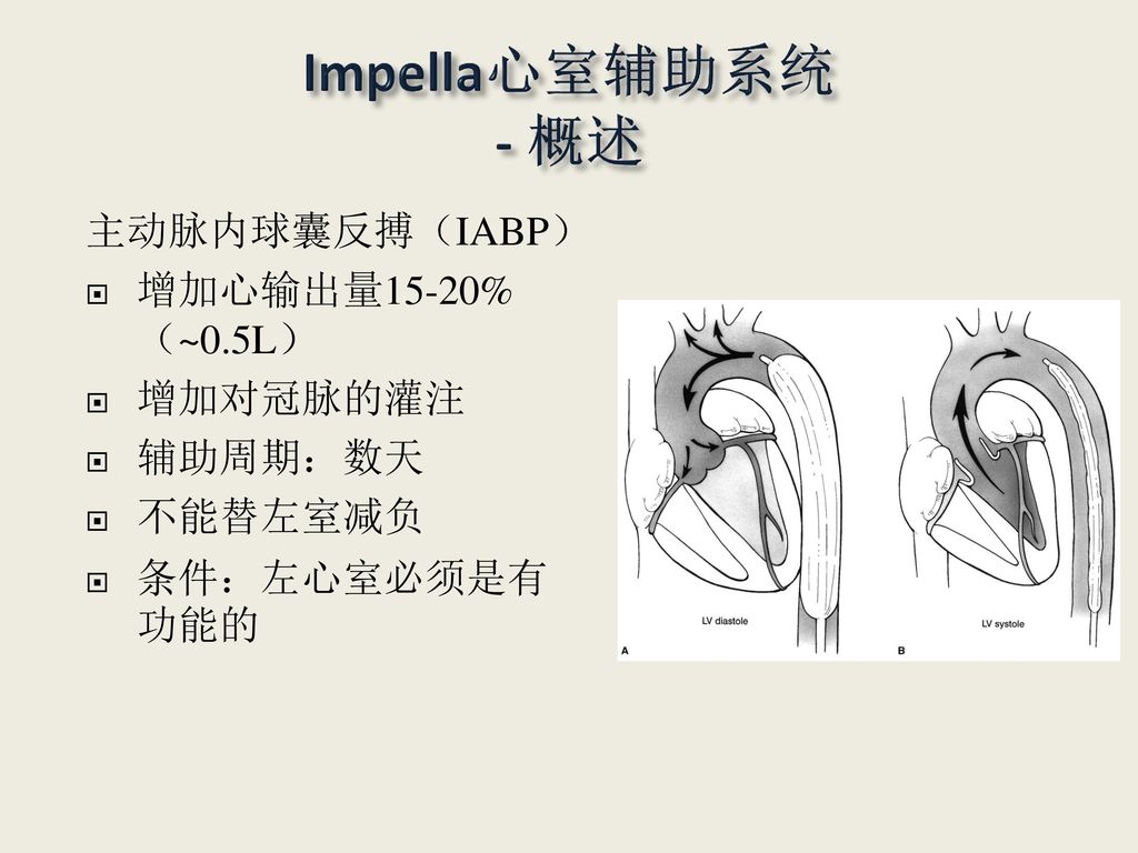 Impella心室辅助系统 - 概述 主动脉内球囊反搏（IABP） 增加心输出量15-20%（~0.5L） 增加对冠脉的灌注 辅助周期：数天