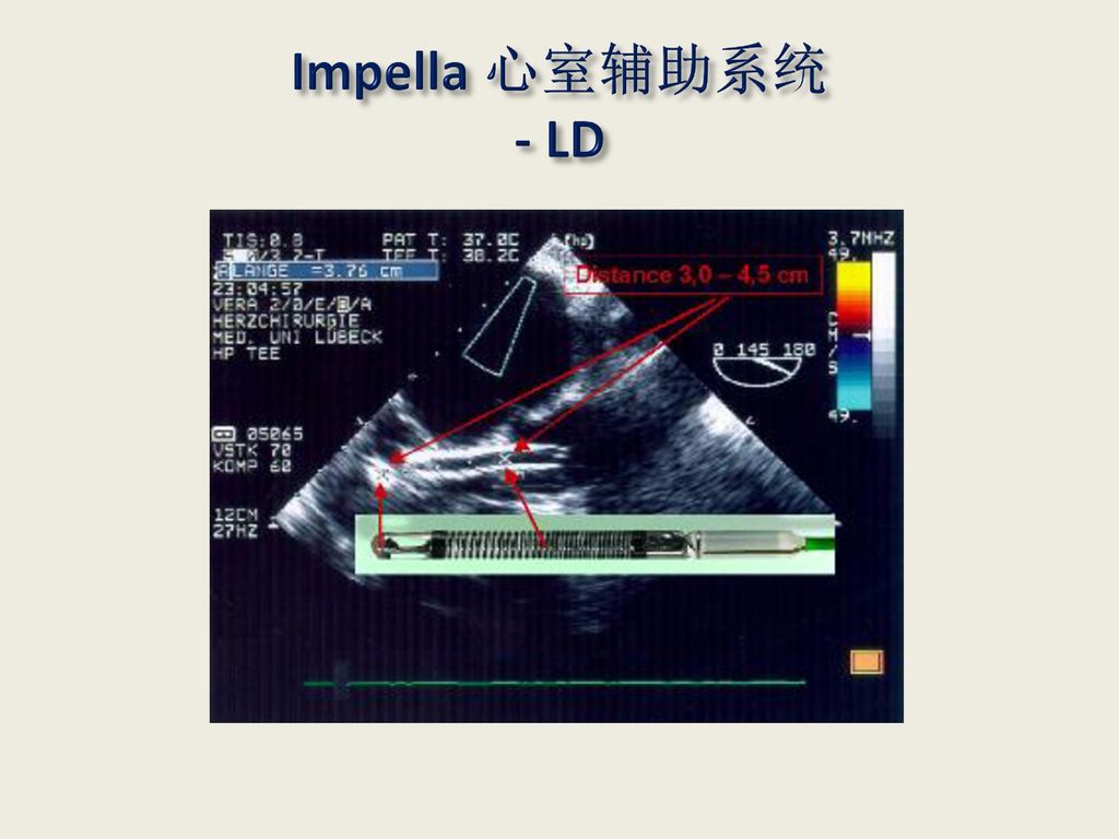 Impella 心室辅助系统 - LD