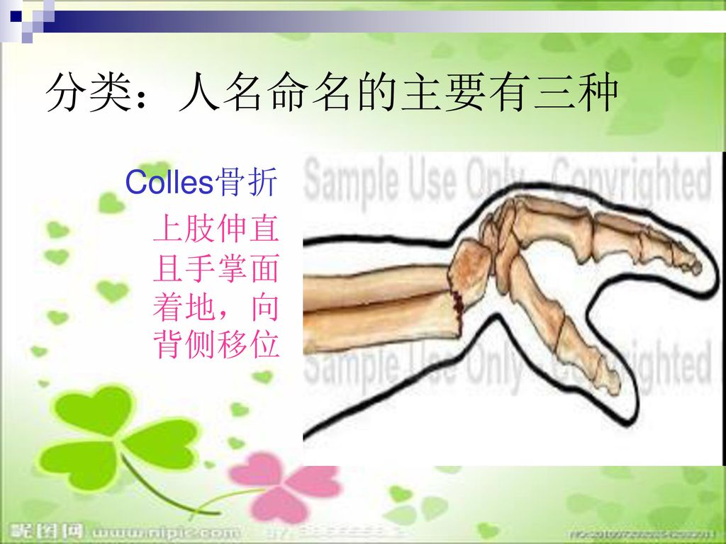 分类：人名命名的主要有三种 Colles骨折 上肢伸直且手掌面着地，向背侧移位