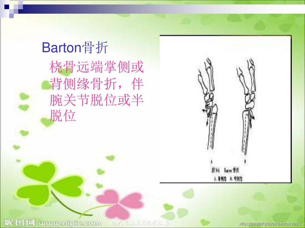 Barton骨折 桡骨远端掌侧或背侧缘骨折，伴腕关节脱位或半脱位