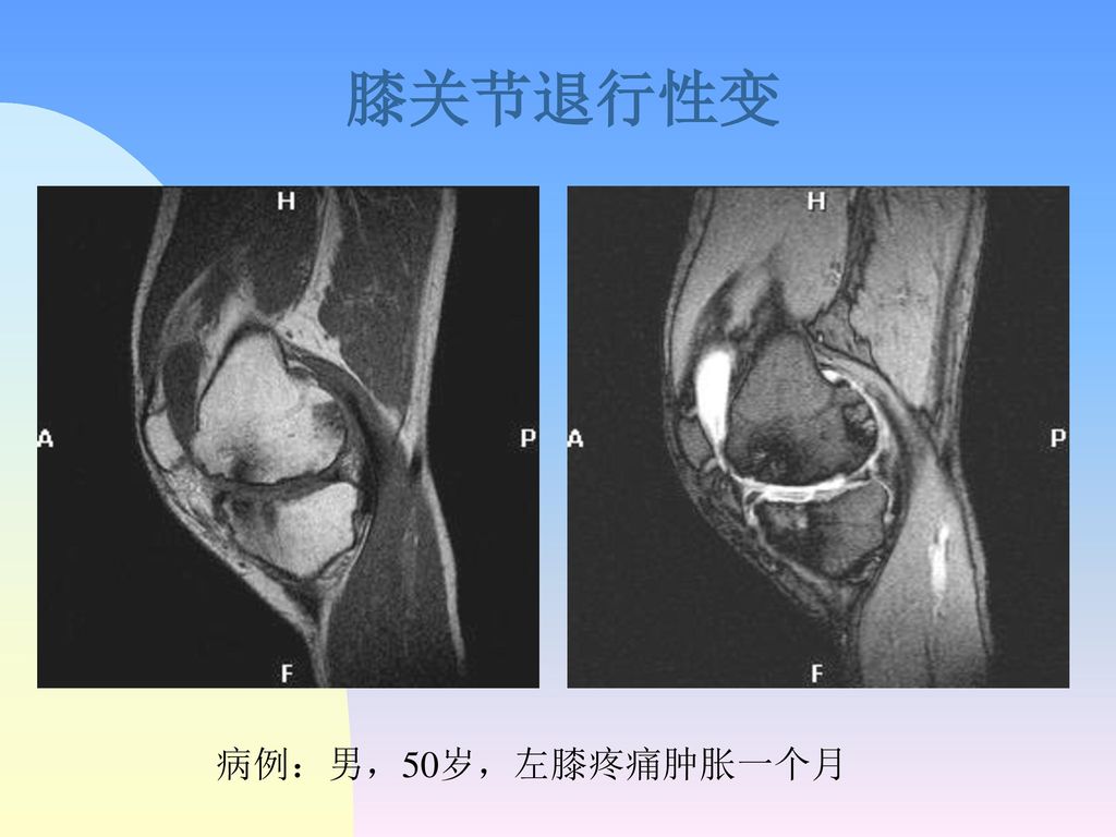 膝关节退行性变 病例：男，50岁，左膝疼痛肿胀一个月