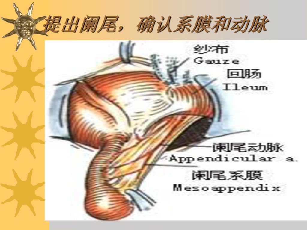 提出阑尾，确认系膜和动脉