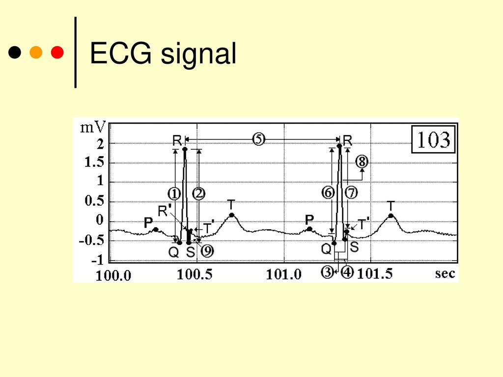 ECG signal