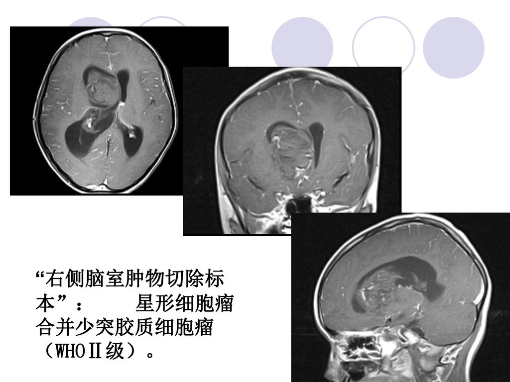 读书报告 －－侧脑室肿瘤的mri诊断 及鉴别诊断 龚 涛 Ppt Download